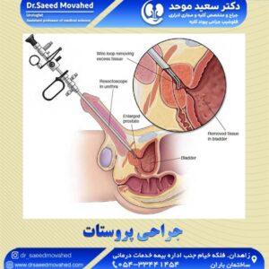 جراحی پروستات- دکتر سعید موحد