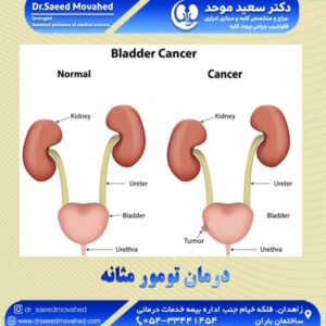 درمان تومور مثانه - دکتر سعید موحد