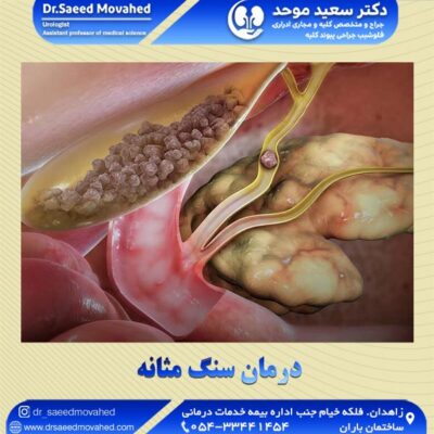 درمان سنگ مثانه - دکتر موحد
